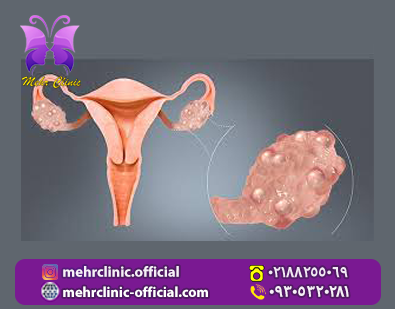 4 - کیست تخمدان خطری مهلک در کمین تمام زنان|😱