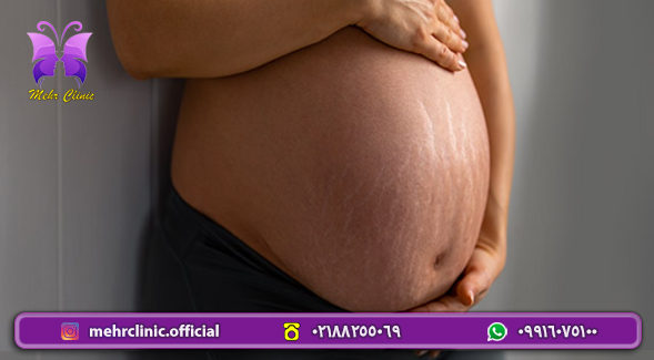 بارداری کلینیک مهر - ترک شکم در بارداری و راهی برای پیشگیری از آن
