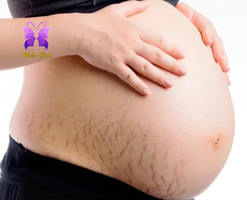 مهر 495x400 - ترک شکم در بارداری و راهی برای پیشگیری از آن
